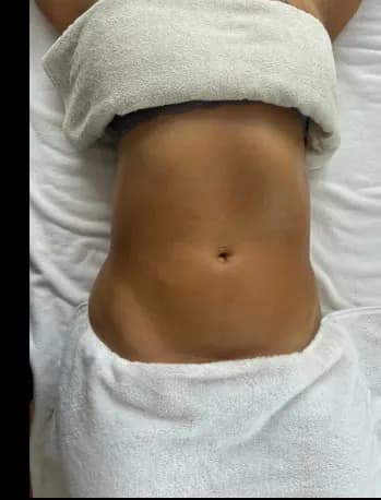 Después — Drenaje