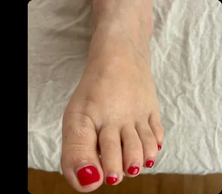 Después — Drenaje