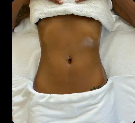 Después — Drenaje