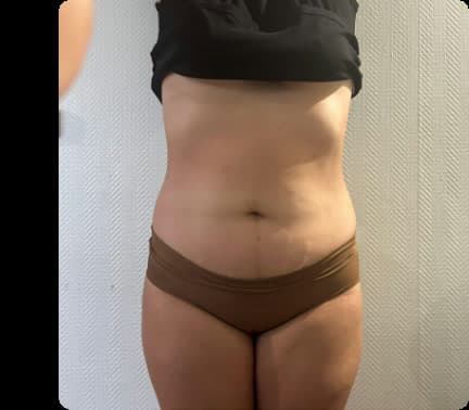 Après — Maderoterapia